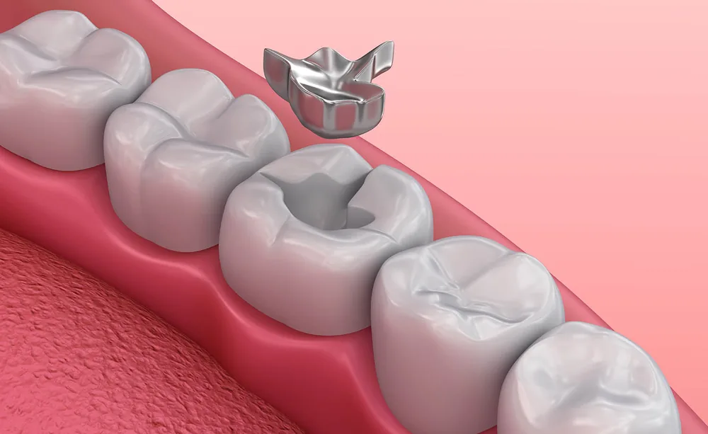 Amalgam Dolgu Nedir? Zararları Nelerdir?