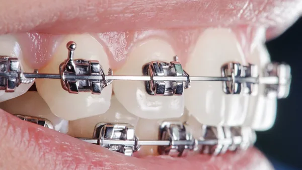 Braket Nedir? Çeşitleri Nelerdir?