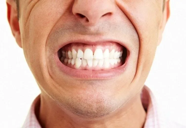 Diş Sıkma ve Gıcırdatma (Bruksizm) Nedir? Dişlere Verdiği Zararlar