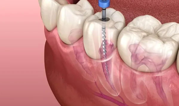 Endodontik Tedavi Nedir ve Nasıl Yapılır?