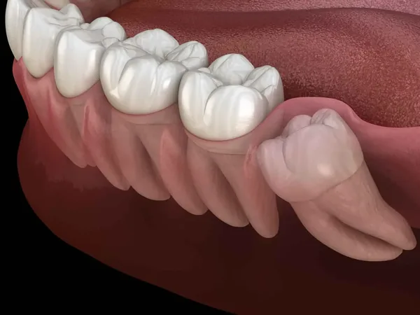 Gömülü Diş Nedir? Gömülü Diş Ameliyatı Nasıl Yapılır?