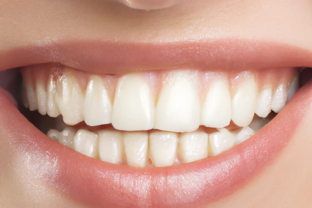 Gummy Smile (Dişeti Gülümsemesi) Nedir? Nedenleri ve Tedavi Yaklaşımları