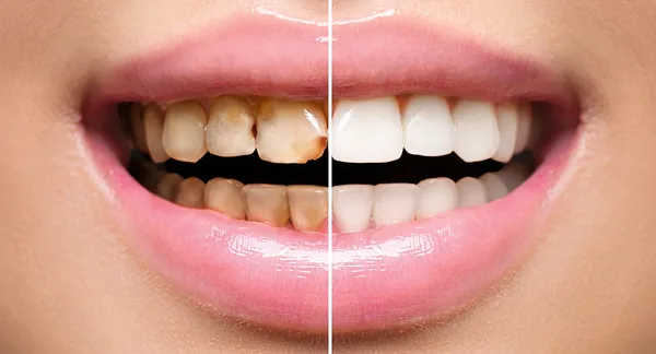 Restoratif Diş Tedavisi Nedir ve Kimlere Uygulanır?